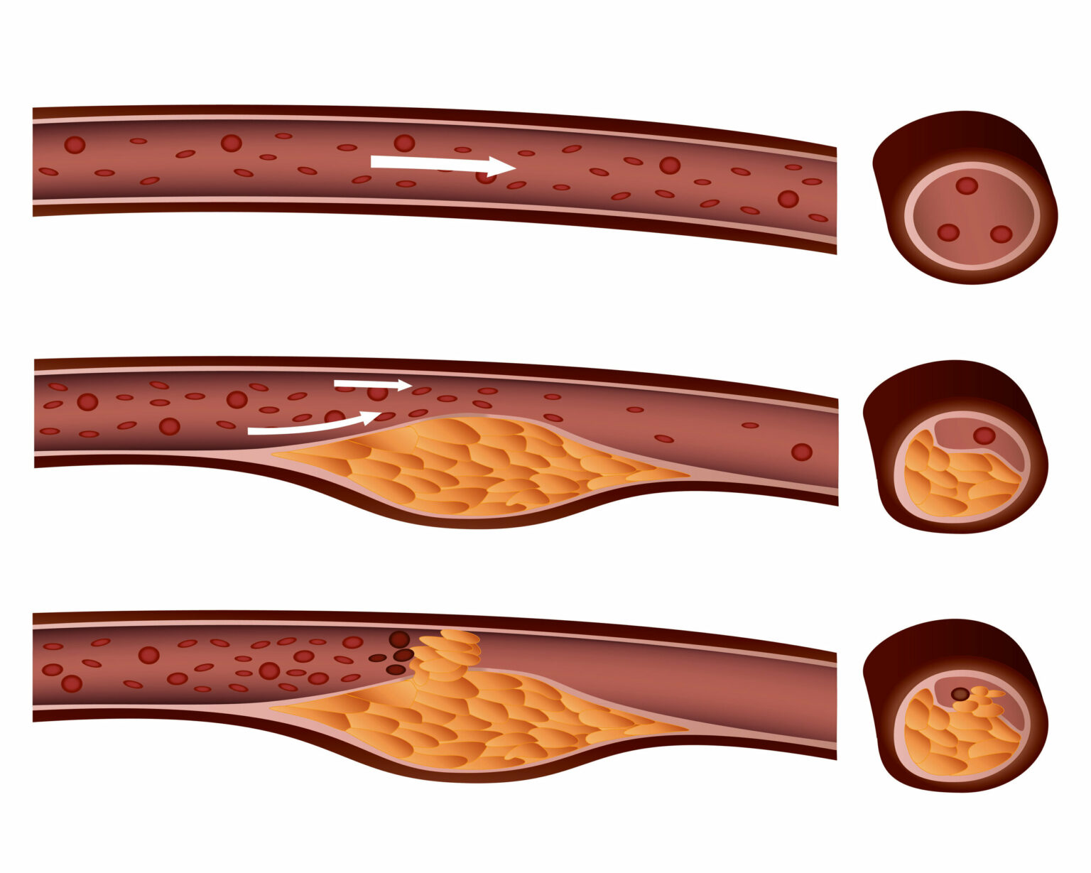 Arterial Occlusion | Causes, Symptoms & Treatment